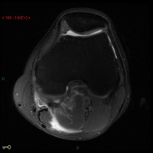 Figure 5 for case Medial head of gastrocnemius muscle ( RID2921 ) avulsion